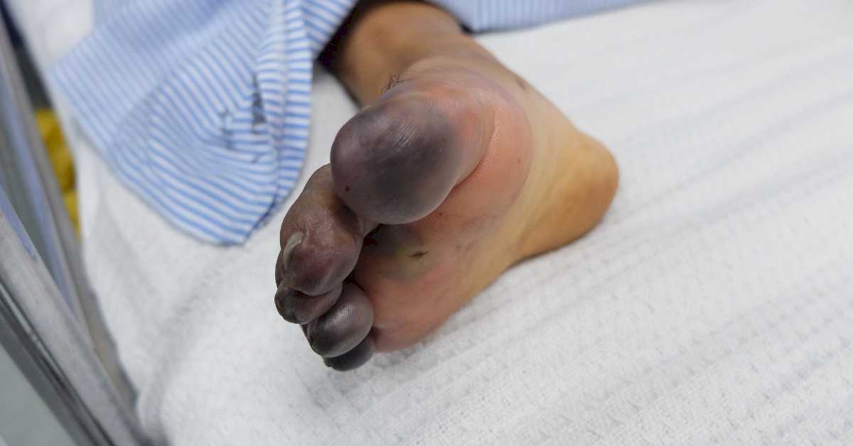 Gangrene  - Diabetasol