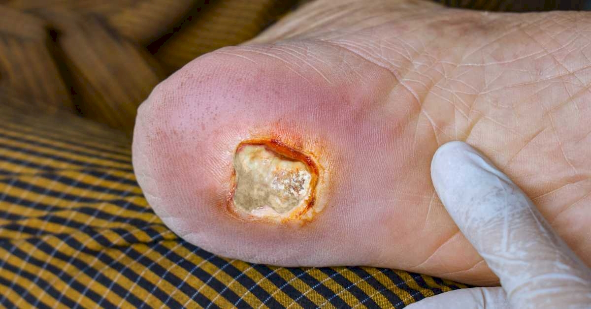 Ulkus kaki (borok) - Diabetasol