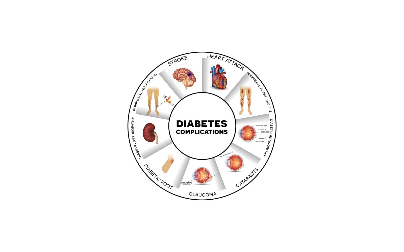 Bagaimana Diabetes Bisa Memicu Stroke?