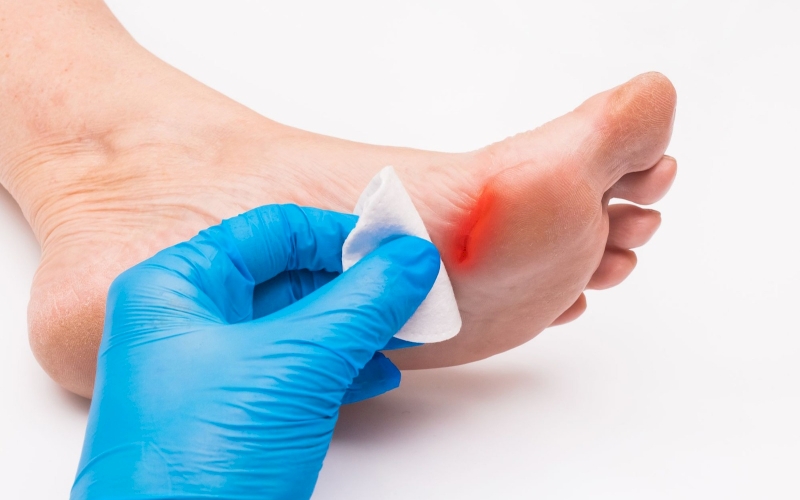 Inilah Cara Merawat Luka Diabetes